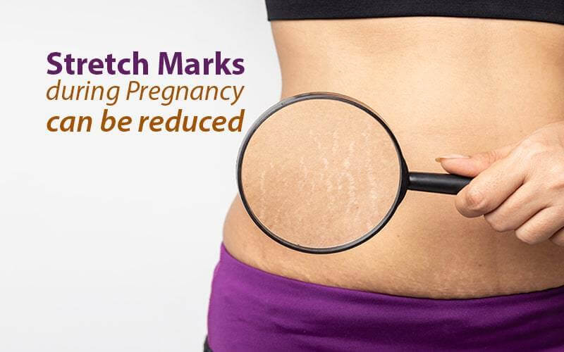 Stretch Marks During Pregnancy Can be Reduced-uyyala-com.myshopify.com-uyyaala com